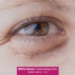 درمان گودی چشم با روش‌های خانگی و کلینیکی