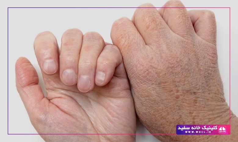 علل ایجاد و نحوه درمان ترک پوست دست و پا