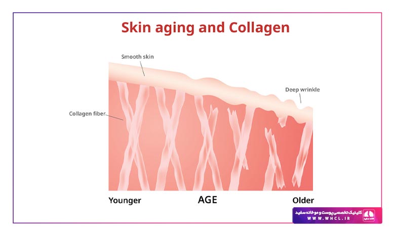 کلاژن چیست و چگونه به کلاژن سازی پوست خود کمک کنیم ؟