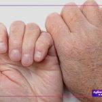 ترک پوست دست و پا | علل ایجاد و نحوه درمان